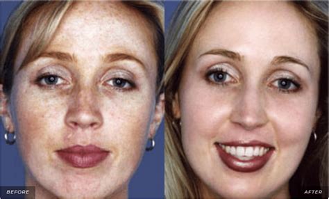 tca chemical peel reviews.